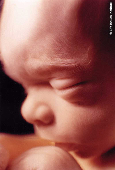 20-week fetus.